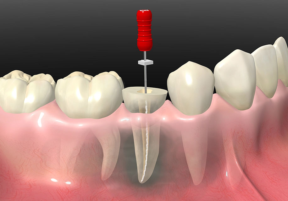 根管治療