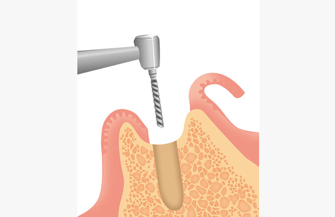 インプラント埋入手術