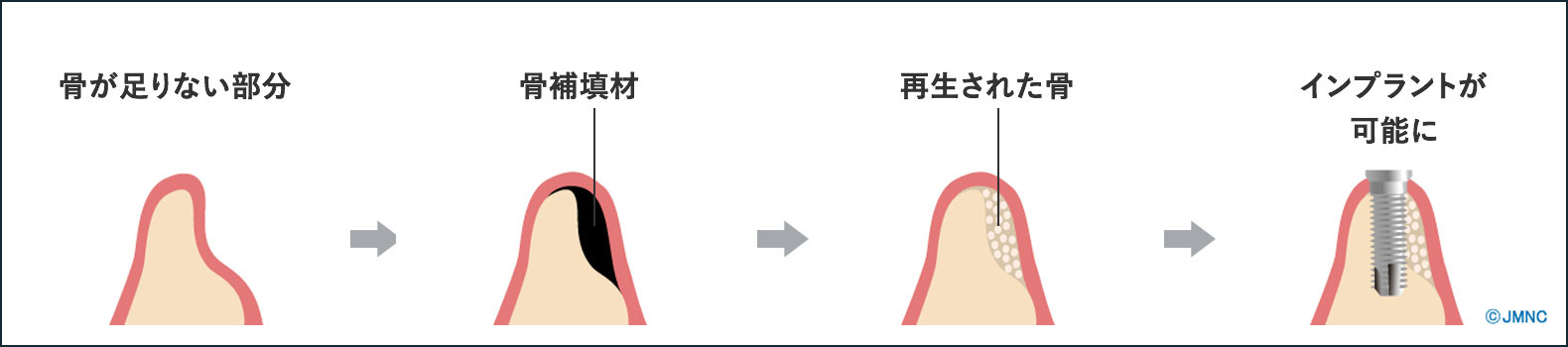 GBR法(骨組織誘導再生法)