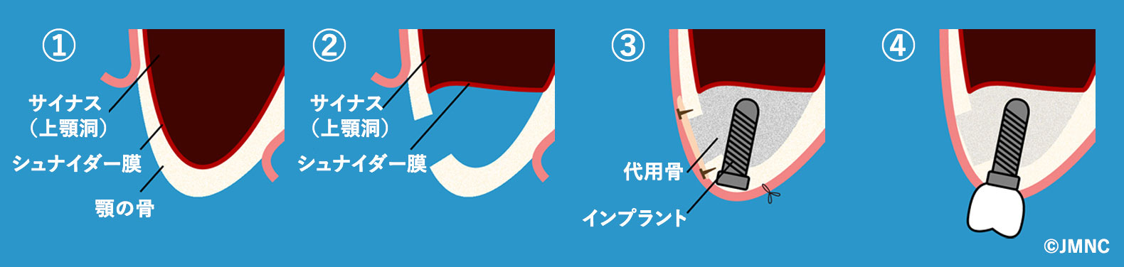 サイナスリフト法(上顎洞底挙上術)