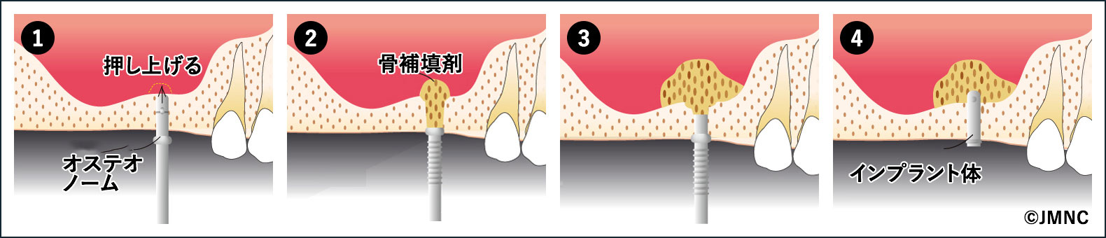 ソケットリフト法(上顎洞底挙上術)